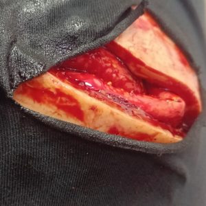 abdominal wound2